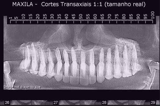 Implante Dentário & TCO Transplante Celular Odontológico